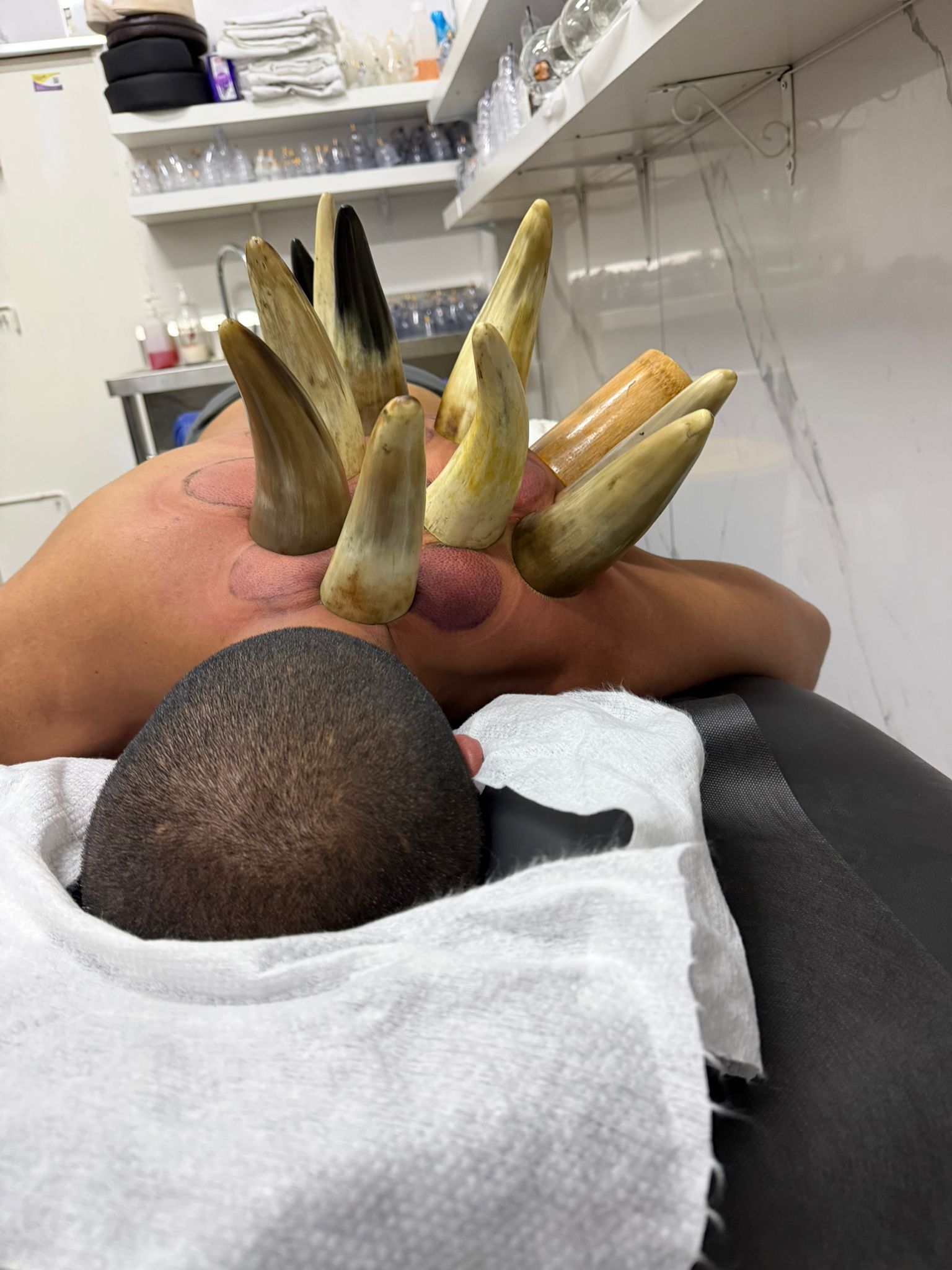 טיפול בקרניים